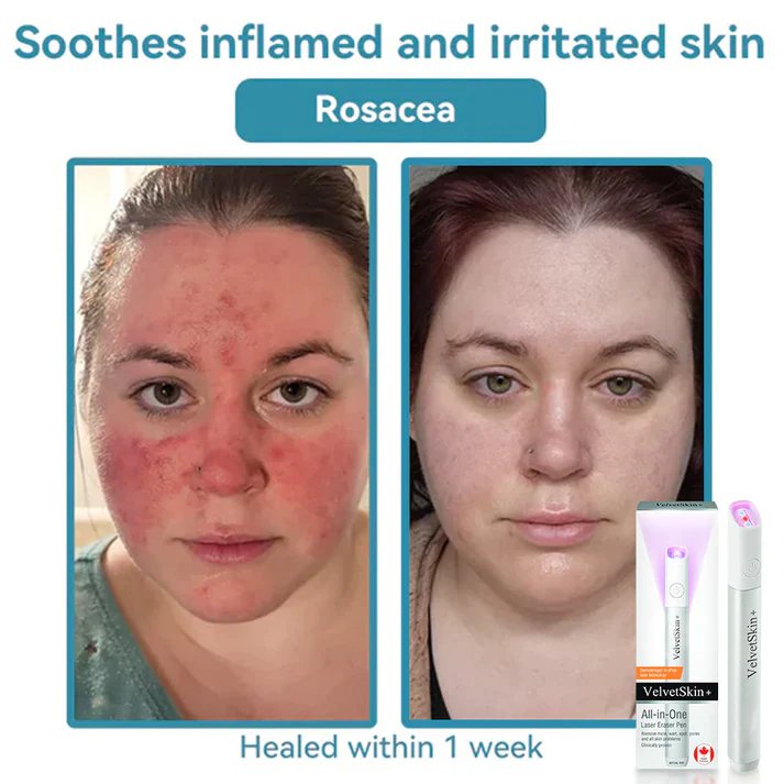 Hopearve™ All-in-One CO₂ Laser Eraser Pen | Removes Moles, Warts, Skin Flaws & Pigmentation