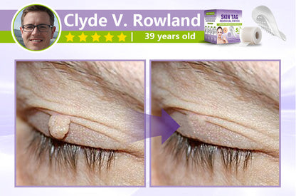 SOLUBLE MICRONEEDLE BOTANICAL SKIN TAG REMOVAL PATCH