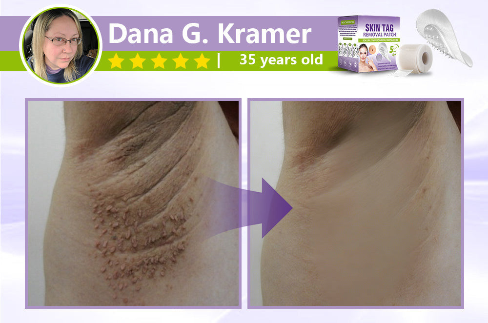 SOLUBLE MICRONEEDLE BOTANICAL SKIN TAG REMOVAL PATCH