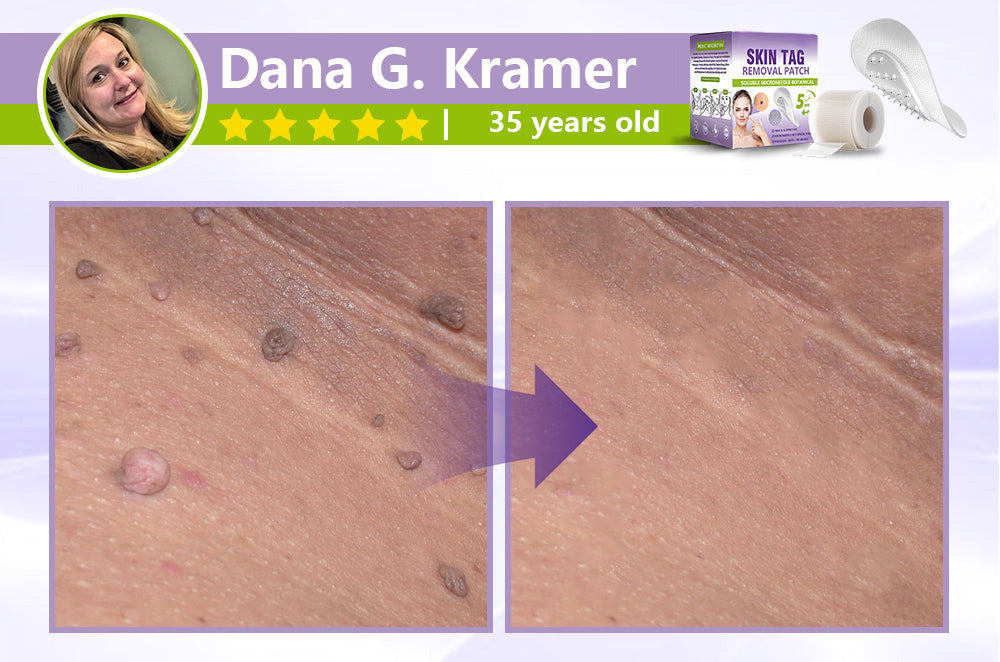 SOLUBLE MICRONEEDLE BOTANICAL SKIN TAG REMOVAL PATCH
