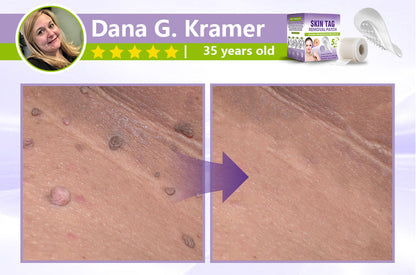 SOLUBLE MICRONEEDLE BOTANICAL SKIN TAG REMOVAL PATCH